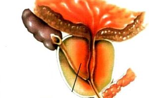 What is the prostatite in men