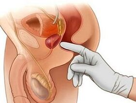 Prostate massage for the treatment of prostatitis in men